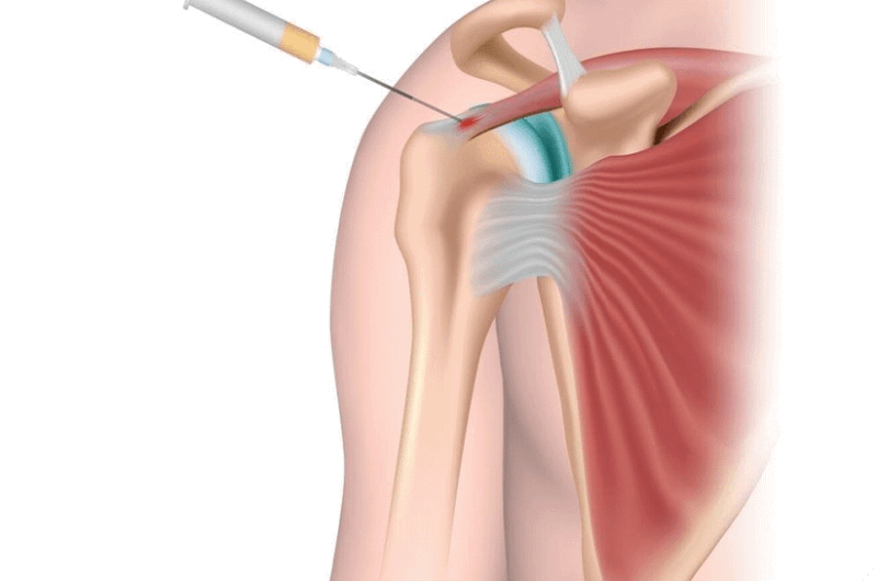 تزریق آرتروز شانه و زانو