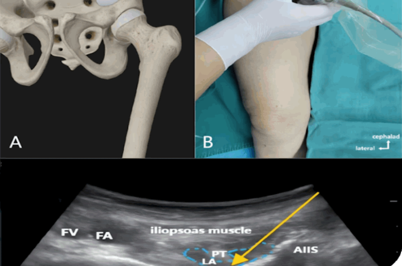 تزریق با هدایت سونوگرافی
