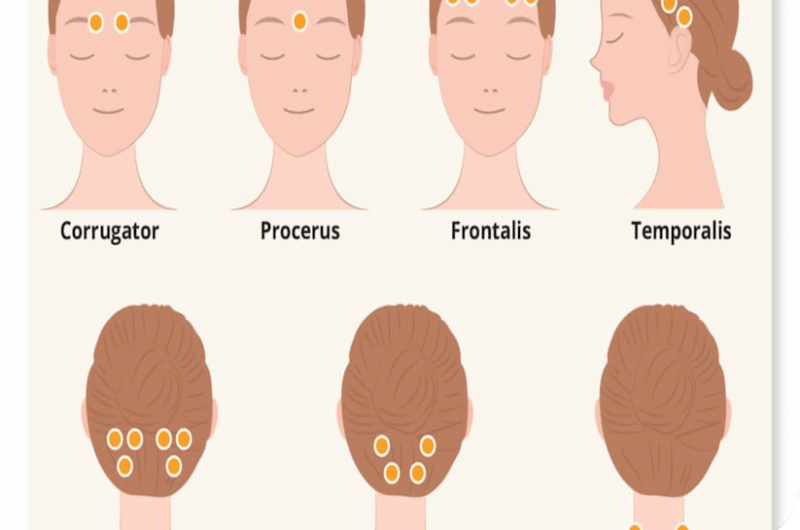 تزریق بوتاکس