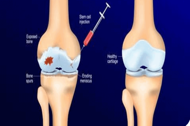 تزریق سلول های بنیادی در آرتروز