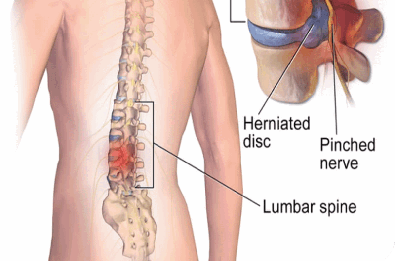کنترل دردهای ناشی از دیسک کمر و گردن